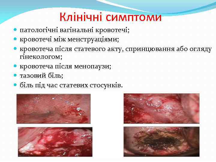  Клінічні симптоми патологічні вагінальні кровотечі; кровотечі між менструаціями; кровотеча після статевого акту, спринцювання