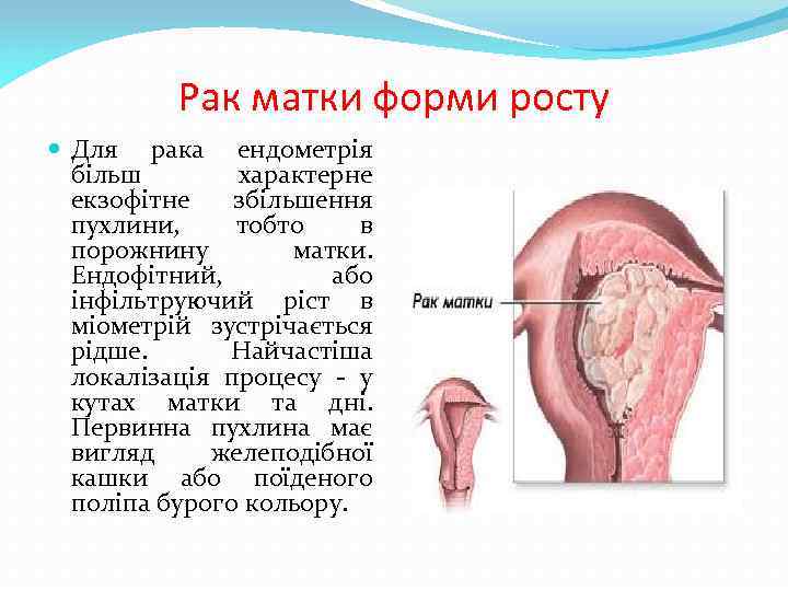 Рак матки форми росту Для рака ендометрія більш характерне екзофітне збільшення пухлини, тобто в