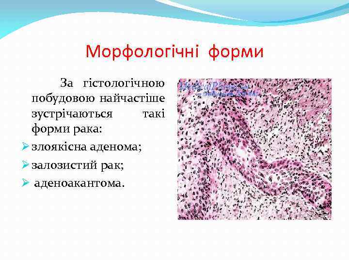 Морфологічні форми За гістологічною побудовою найчастіше зустрічаються такі форми рака: Ø злоякісна аденома; Ø