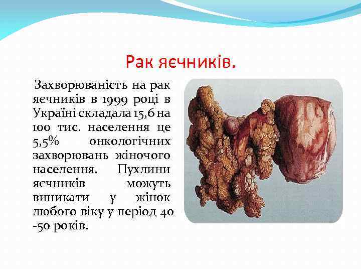 Рак яєчників. Захворюваність на рак яєчників в 1999 році в Україні складала 15, 6