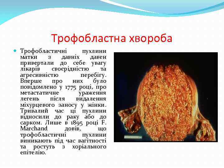 Трофобластна хвороба Трофобластичні пухлини матки з давніх давен привертали до себе увагу лікарів своєрідністю