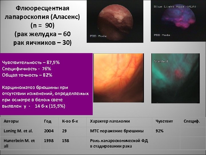 Флюоресцентная лапароскопия (Аласенс) (n = 90) (рак желудка – 60 рак яичников – 30)