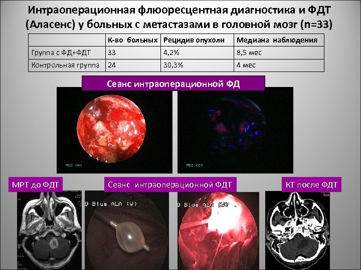 Интраоперационная флюоресцентная диагностика и ФДТ (Аласенс) у больных с метастазами в головной мозг (n=33)