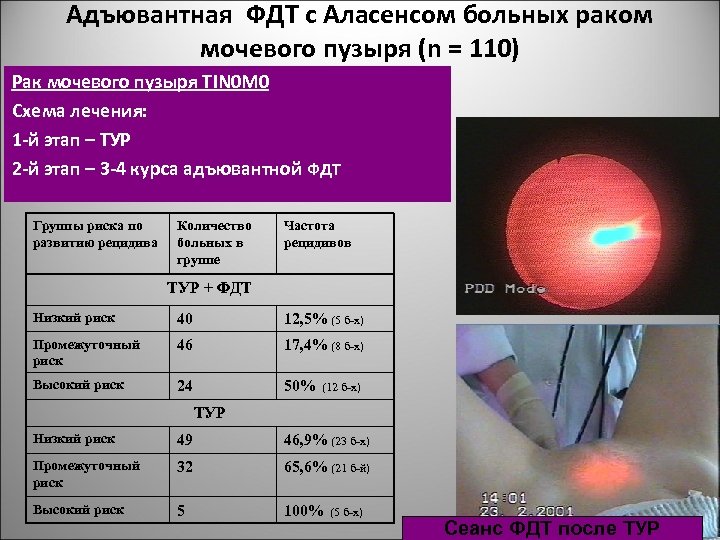 Адъювантная ФДТ с Аласенсом больных раком мочевого пузыря (n = 110) Рак мочевого пузыря