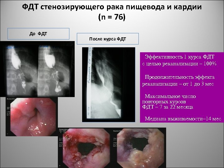 ФДТ стенозирующего рака пищевода и кардии (n = 76) До ФДТ После курса ФДТ