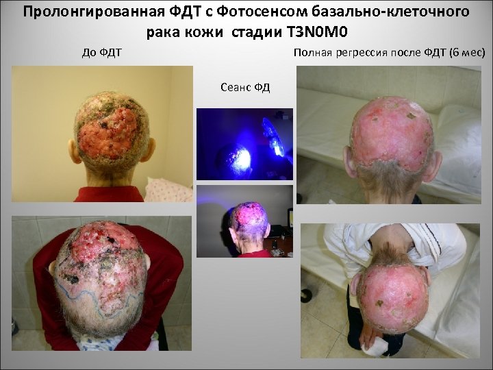 Пролонгированная ФДТ с Фотосенсом базально-клеточного рака кожи стадии T 3 N 0 M 0