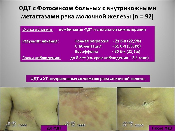 ФДТ с Фотосенсом больных с внутрикожными метастазами рака молочной железы (n = 92) Схема