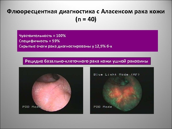 Флюоресцентная диагностика с Аласенсом рака кожи (n = 40) Чувствительность = 100% Специфичность =