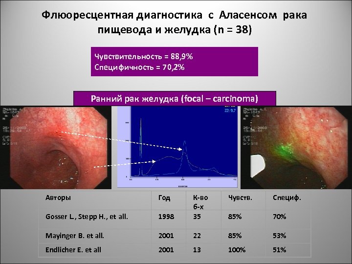 Флюоресцентная диагностика с Аласенсом рака пищевода и желудка (n = 38) Чувствительность = 88,