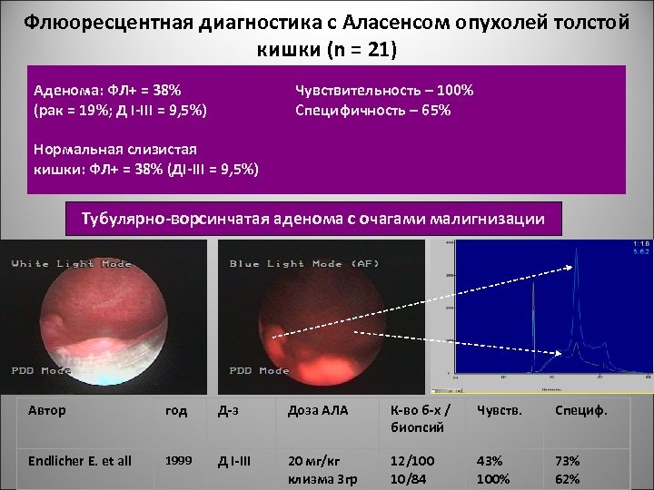 Флюоресцентная диагностика с Аласенсом опухолей толстой кишки (n = 21) Аденома: ФЛ+ = 38%