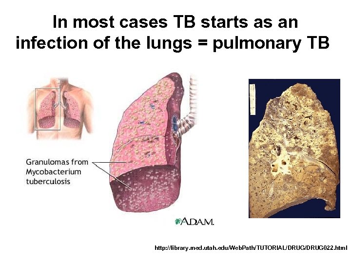In most cases TB starts as an infection of the lungs = pulmonary TB