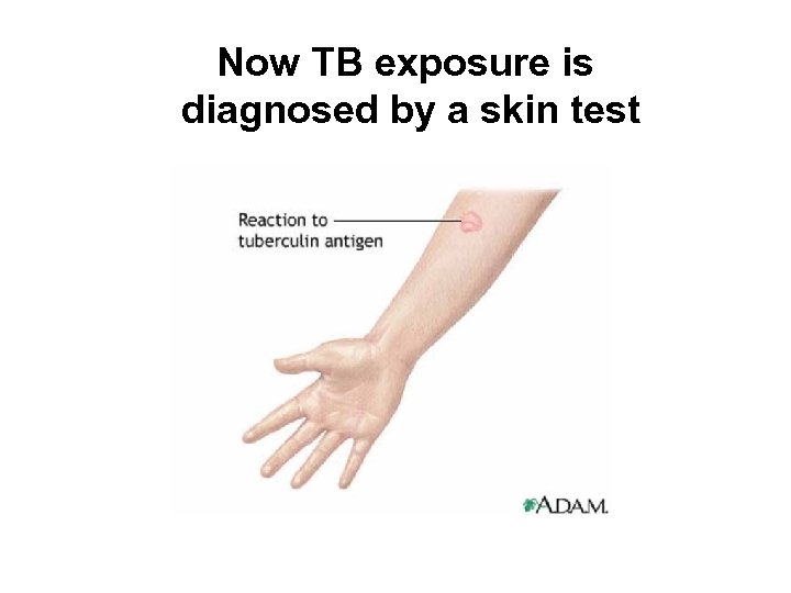 Now TB exposure is diagnosed by a skin test 