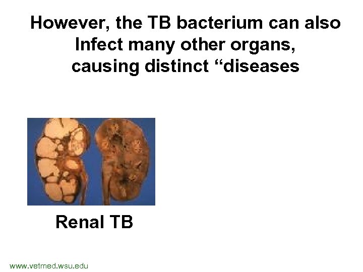 However, the TB bacterium can also Infect many other organs, causing distinct “diseases Renal