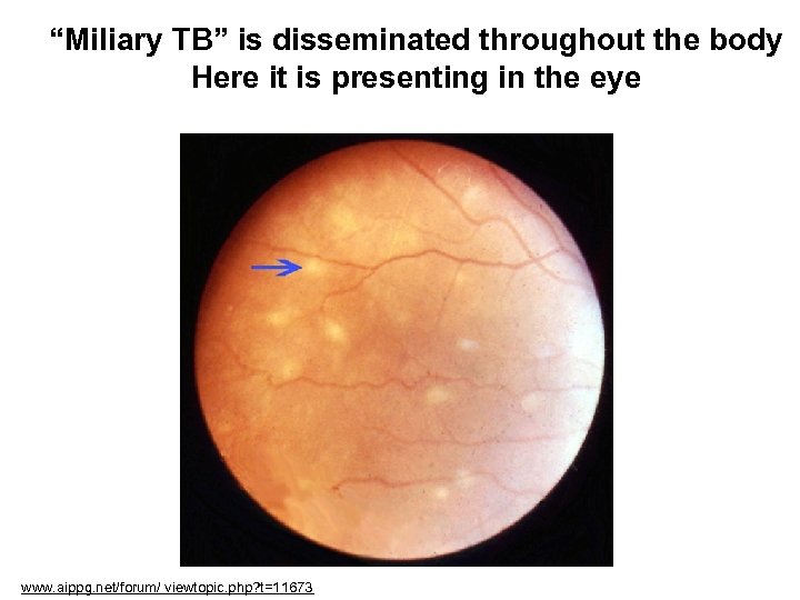 “Miliary TB” is disseminated throughout the body Here it is presenting in the eye