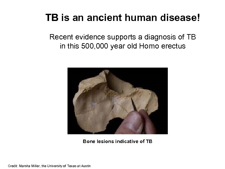 TB is an ancient human disease! Recent evidence supports a diagnosis of TB in