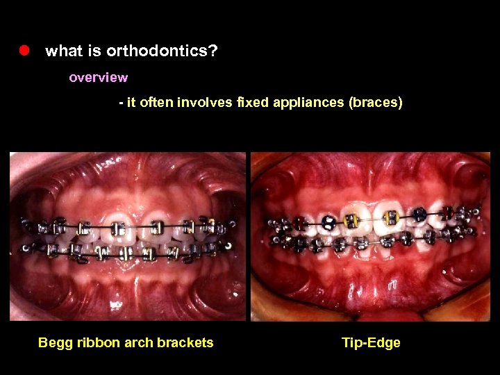 l what is orthodontics? overview - it often involves fixed appliances (braces) Begg ribbon