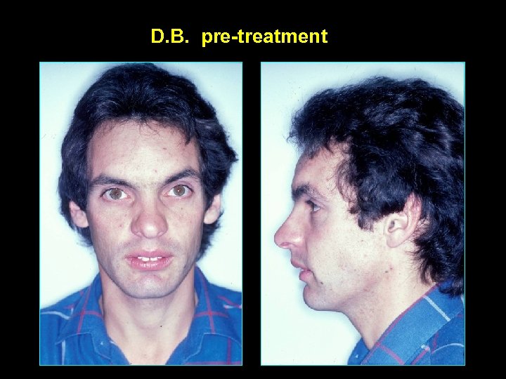 D. B. pre-treatment 