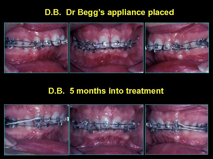 D. B. Dr Begg’s appliance placed D. B. 5 months into treatment 