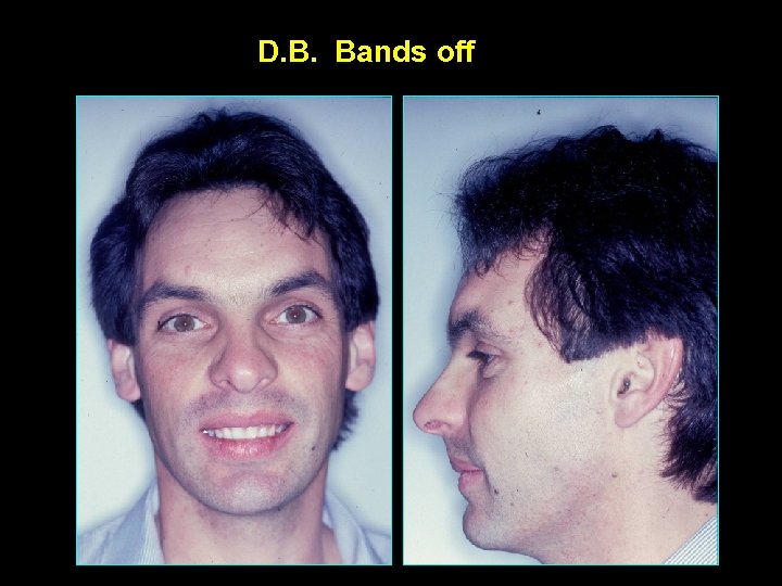 D. B. Bands off 