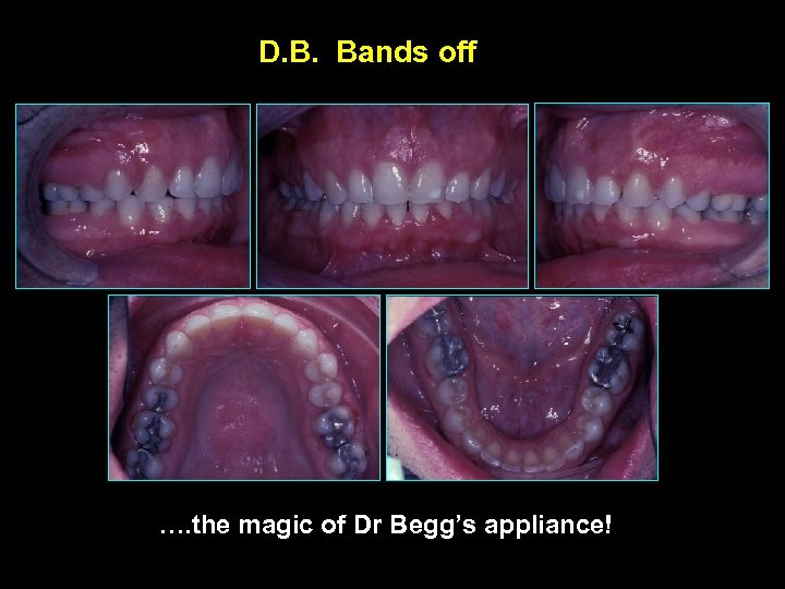 D. B. Bands off …. the magic of Dr Begg’s appliance! 