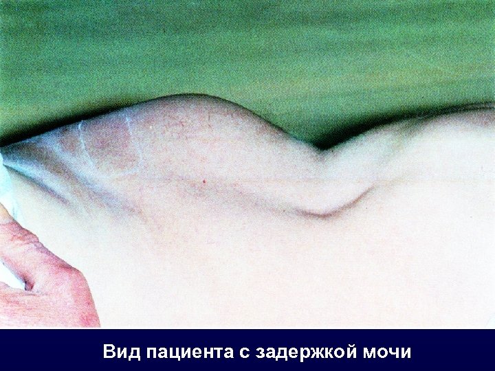 Вид пациента с задержкой мочи 