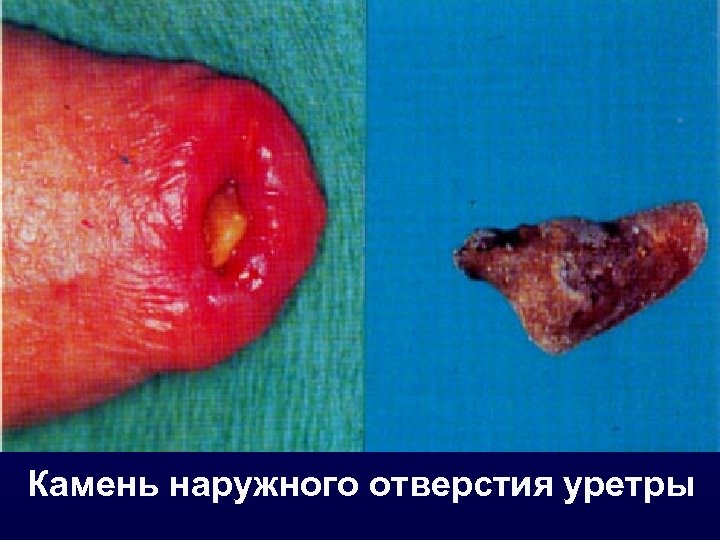 Камень наружного отверстия уретры 