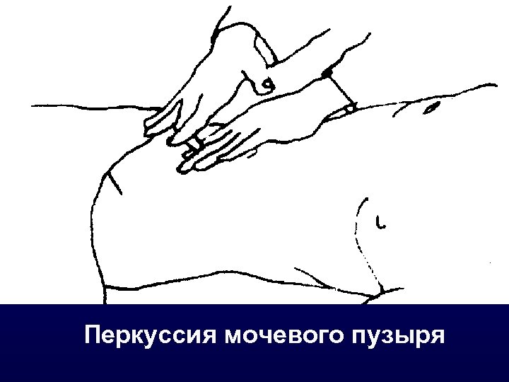 Перкуссия мочевого пузыря 