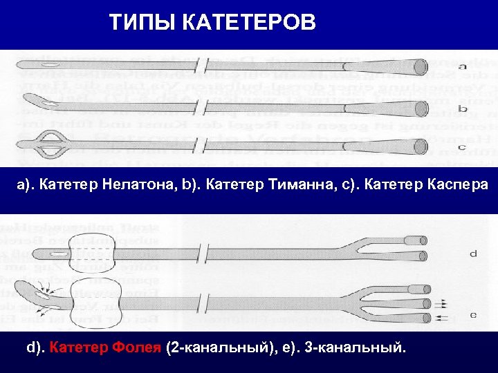 ТИПЫ КАТЕТЕРОВ a). Катетер Нелатона, b). Катетер Тиманна, c). Катетер Каспера d). Катетер Фолея