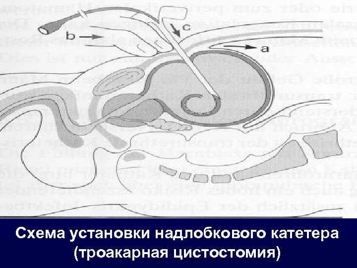 Цистостомия. Операция троакарная цистостомия. Троакарная пункция мочевого пузыря. Надлобковая троакарная цистостомия. Троокарная синусотомия.