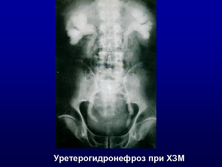 Уретерогидронефроз при ХЗМ 