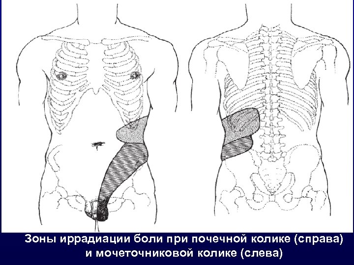 Зоны иррадиации боли при почечной колике (справа) и мочеточниковой колике (слева) 