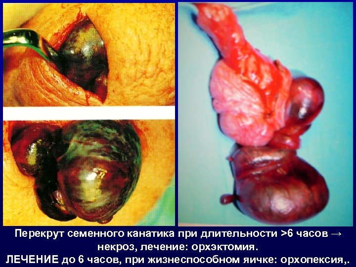 Перекрут семенного канатика при длительности >6 часов → некроз, лечение: орхэктомия. ЛЕЧЕНИЕ до 6