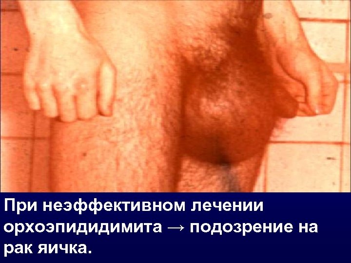 При неэффективном лечении орхоэпидидимита → подозрение на рак яичка. 