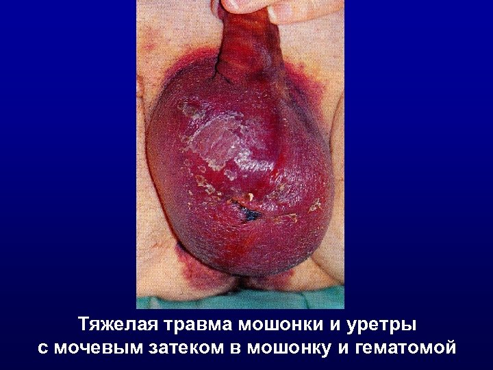 Тяжелая травма мошонки и уретры с мочевым затеком в мошонку и гематомой 