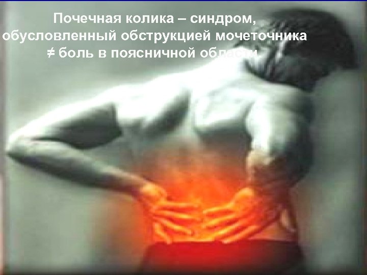 Почечная колика – синдром, обусловленный обструкцией мочеточника ≠ боль в поясничной области. 