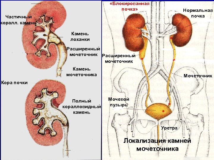  «Блокированная почка» Нормальная почка Частичный коралл. камень Камень лоханки Расширенный мочеточник Камень мочеточника
