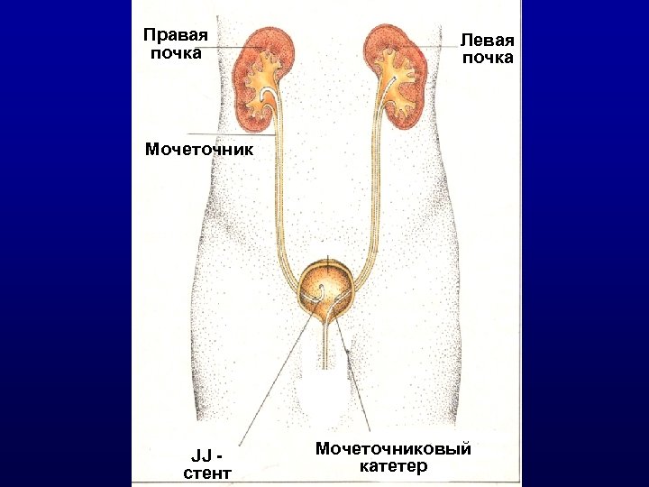 Правая почка Левая почка Мочеточник JJ стент Мочеточниковый катетер 