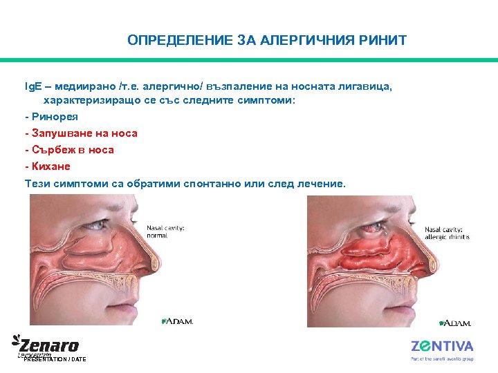 ОПРЕДЕЛЕНИЕ ЗА АЛЕРГИЧНИЯ РИНИТ Ig. E – медиирано /т. е. алергично/ възпаление на носната