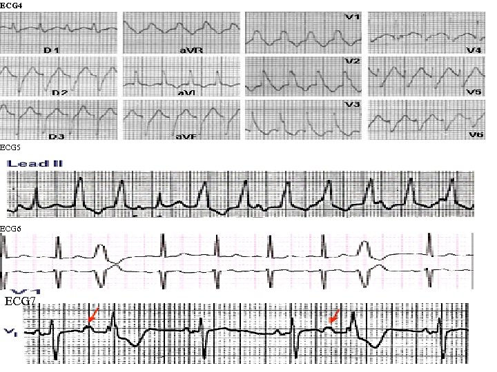 ECG 4 ECG 5 ECG 6 ECG 7 