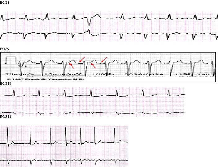 ECG 8 ECG 9 ECG 10 ECG 11 