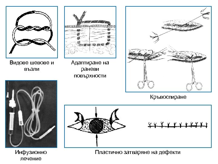 Видове шевове и възли Адаптиране на раневи повърхности Кръвоспиране Инфузионно лечение Пластично затваряне на