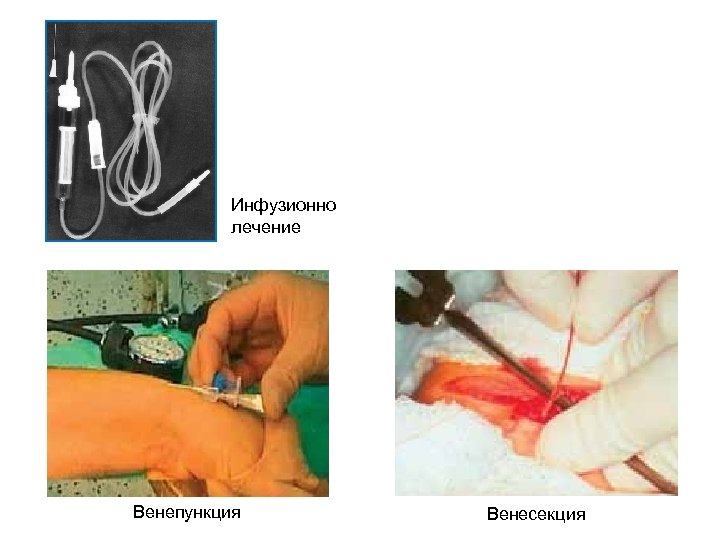 Инфузионно лечение Венепункция Венесекция 