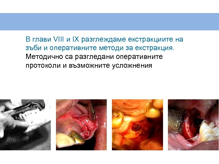 В глави VIII и IX разглеждаме екстракциите на зъби и оперативните методи за екстракция.