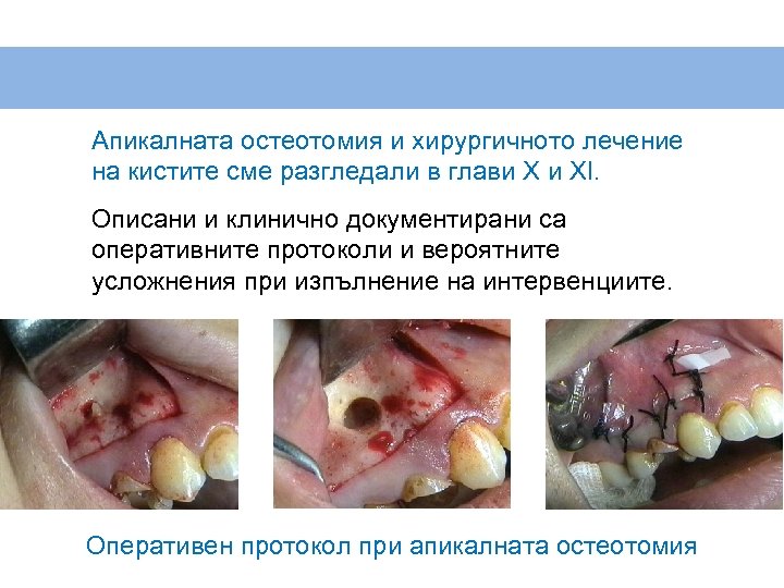 Апикалната остеотомия и хирургичното лечение на кистите сме разгледали в глави X и XI.