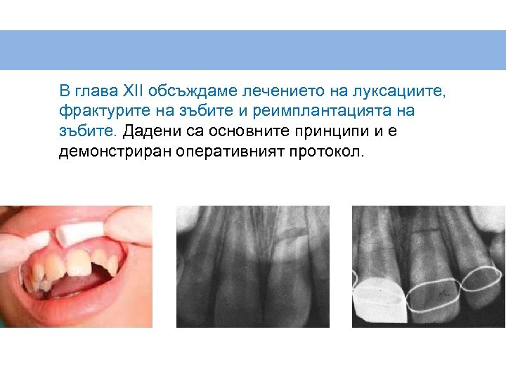 В глава XII обсъждаме лечението на луксациите, фрактурите на зъбите и реимплантацията на зъбите.