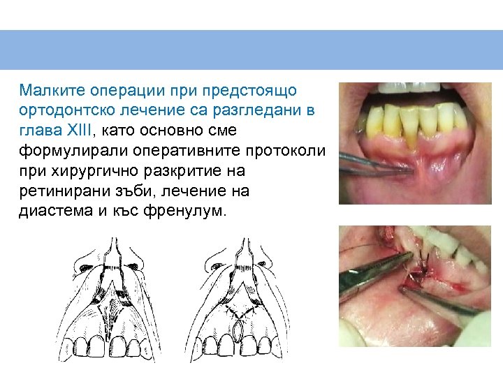 Малките операции предстоящо ортодонтско лечение са разгледани в глава XIII, като основно сме формулирали