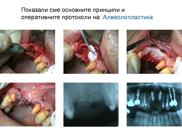Показали сме основните принципи и оперативните протоколи на: Алвеолопластика 