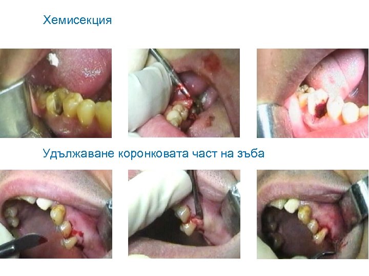 Хемисекция Удължаване коронковата част на зъба 