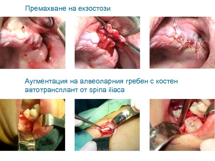 Премахване на екзостози Аугментация на алвеоларния гребен с костен автотрансплант от spina iliaca 