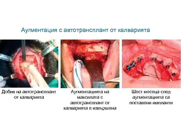 Аугментация с автотрансплант от калварията Добив на автотрансплант от калварията Аугментацията на максилата с